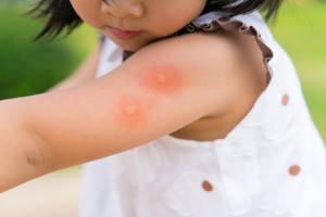 Аллергия комар