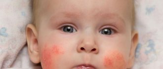 Аллергия на лице у грудничка при грудном вскармливании возникает при несоблюдении диеты кормящей матерью