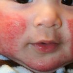 Аллергия на щеках у малыша