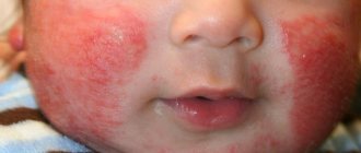 Allergy on the baby's cheeks