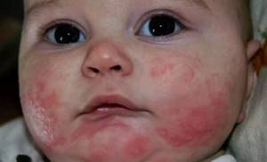 Аллергия на сладкое у детей