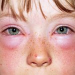 аллергия на сладкое у ребенка