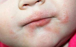 аллергия на сладкое у ребенка