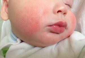 Аллергия у младенца