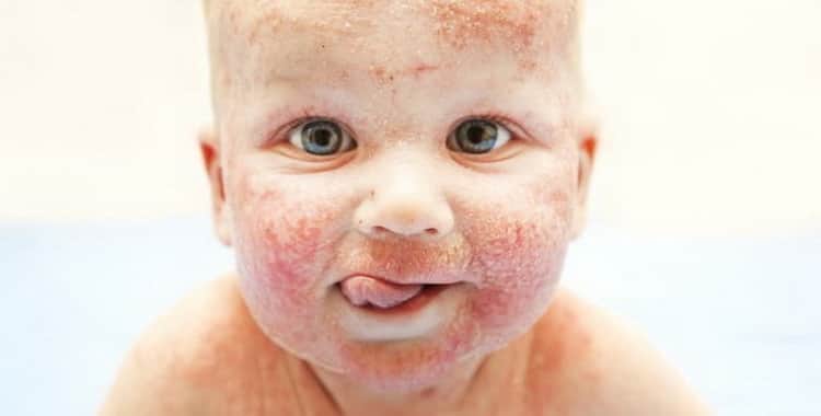 Аллергия у новорожденных: симптомы, лечение