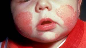 Атопический дерматит довольно опасен, поскольку ребенок может сам занести в кровь инфекцию, расчесывая высыпания.