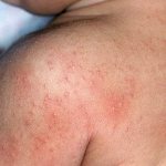 atopic dermatitis - photo