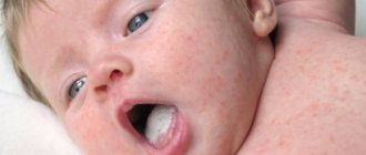 White plaque in the mouth