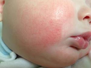 Чем лечить обморожение щек у ребенка