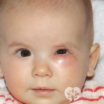 Дакриоцистит у новорожденных: симптомы и лечение