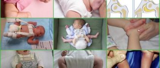 dysplasia in a newborn