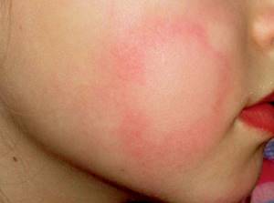 холодовая аллергия на щеках