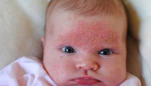 Как лечить себорейный дерматит у детей? Лекарства и уходовые средства