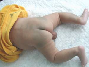 Как выглядит монгольское пятно на копчике у новорожденного