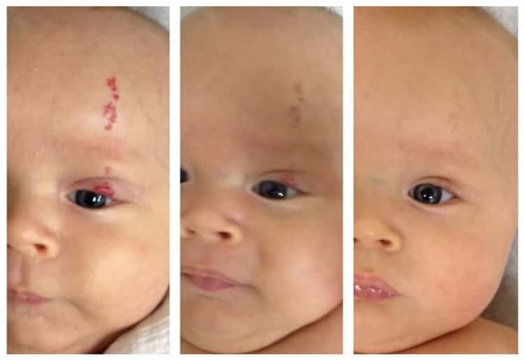 Как выглядят родимые пятна у новорожденных на голове