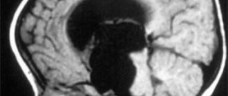 Cyst in a newborn&#39;s head