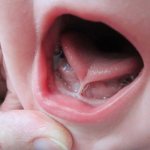 short frenulum of the tongue