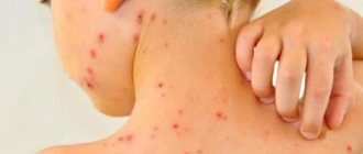 Rubella