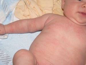 Красные прыщи на теле чешутся у ребенка — Аллергия и я