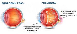 механизм глаукомы