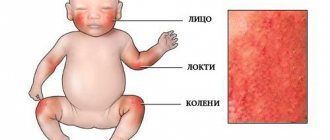 места проявления сыпи при аллергии у ребенка