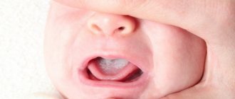 Молочница у детей во рту: лечение, симптомы, причины кандидоза полости рта