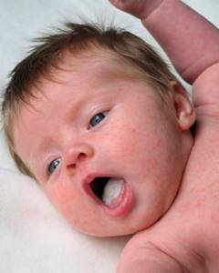 Молочница в кишечнике у ребенка