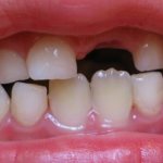молочные зубы когда выпадают сроки и порядок