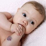 Mongolian spot on a child&#39;s hand