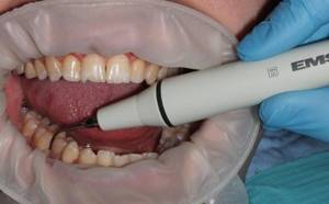 Можно ли лечить зубы при лактации с анестезией