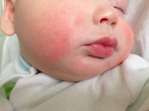 Мраморная кожа у ребенка причины комаровский