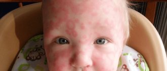 The initial stage of urticaria in children: photo of the rash