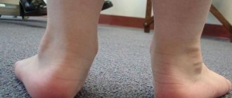 ноги ребенка с вальгусной деформацией стопы