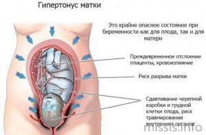 Определение гипертонуса матки