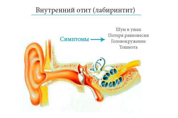 Острый отит внутреннего уха или лабиринтит