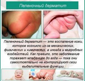 Пеленочный дерматит у новорожденных. Фото, лечение, клинические рекомендации