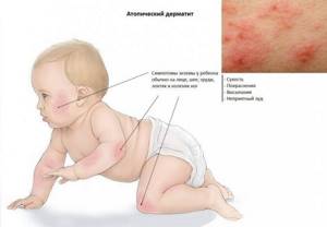 Пищевая аллергия у ребенка в 2 года может проявиться в виде атопического дерматита.