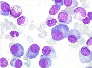 Плазматические клетки 1 в общем анализе крови
