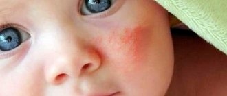 Поговорим о пищевой аллергии у детей и лечении этого недуга.