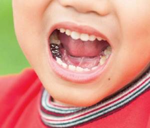 Показания к установке коронок детям на молочные зубы