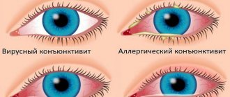 Popular types of conjunctivitis