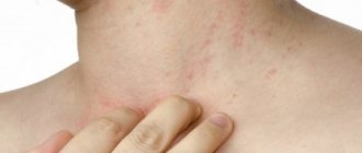 Появление потницы связано с воспалением кожных покровов в итоге гипергидроза