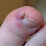 признаки вросшего ногтя на ноге у ребенка