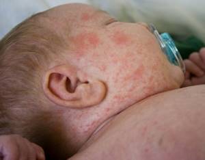 Прыщики у новорожденного на лице с белыми головками, похожие на укусы комаров. Причины, лечение, чем обрабатывать