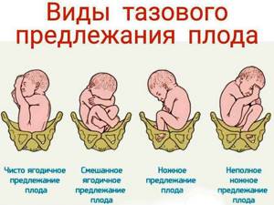 Расположение ребенка в животе по неделям беременности