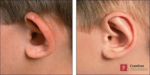 разные уши у ребенка