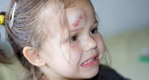 ребенок упал и ударился головой комаровский опасные последствия