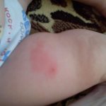 Lump at the vaccination site