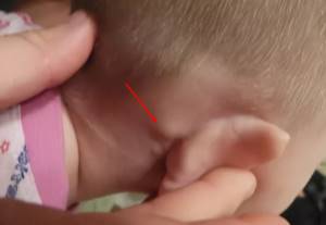 Шишка за ухом у ребенка: что это может быть и каковы причины возникновения маленьких уплотнений?