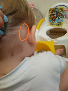 Шишка за ухом у ребенка: что это может быть и каковы причины возникновения маленьких уплотнений?